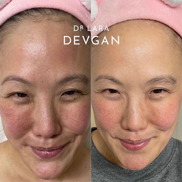 Real Client Stories: Hyperpigmentation and Fine Lines