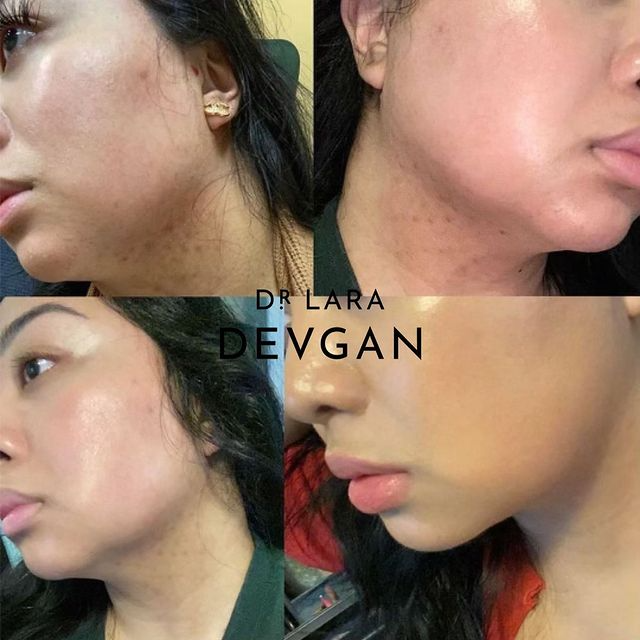 Real Client Stories: Acne and Irritation