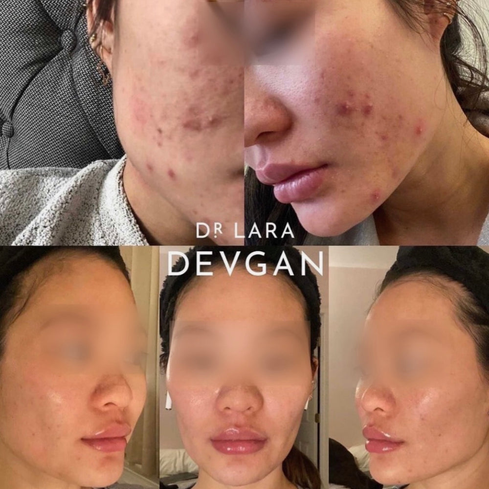Real Client Stories: Acne and Acne Scarring
