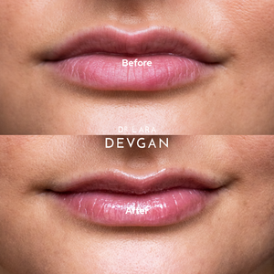 Platinum Lip Plump Dr. Lara Devgan Skincare Platinum Lip Plump Dr. Lara Devgan Skincare