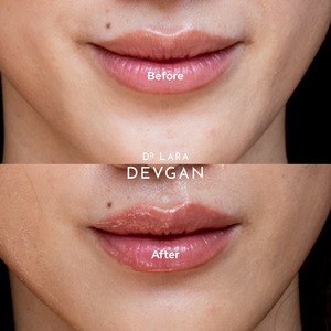 【玄人専用】 黎明の先 LemonLimeリキッド1.0ml H4CBH251 Platinum Lip Plump – Dr. Lara Devgan Skincare