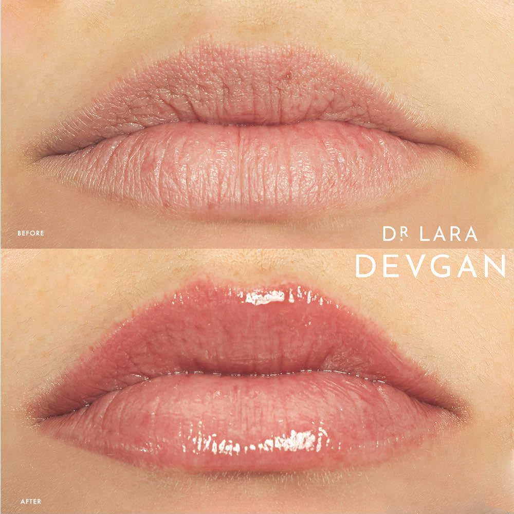 
                  
                    Load image into Gallery viewer, Platinum Lip Plump
                  
                