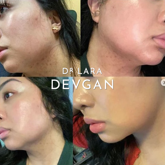 Using Alpha Hydroxy Pads Alpha Beta Hydroxy Pads – Dr. Lara Devgan Skincare