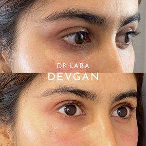 
                  
                    Load image into Gallery viewer, BEAUTY METRICS: Lecture 2 | Tear Trough Augmentation
                  
                