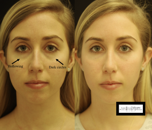 
                  
                    Load image into Gallery viewer, BEAUTY METRICS: Lecture 2 | Tear Trough Augmentation
                  
                