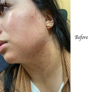 
                  
                    Load image into Gallery viewer, Real Client Stories: Acne and Irritation
                  
                