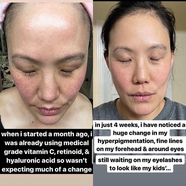 
                  
                    Load image into Gallery viewer, Real Client Stories: Hyperpigmentation and Fine Lines
                  
                