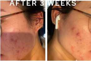 
                  
                    Load image into Gallery viewer, Real Client Stories: Acne and Acne Scarring
                  
                