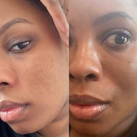 
                  
                    Load image into Gallery viewer, Real Client Stories: Hyperpigmentation
                  
                